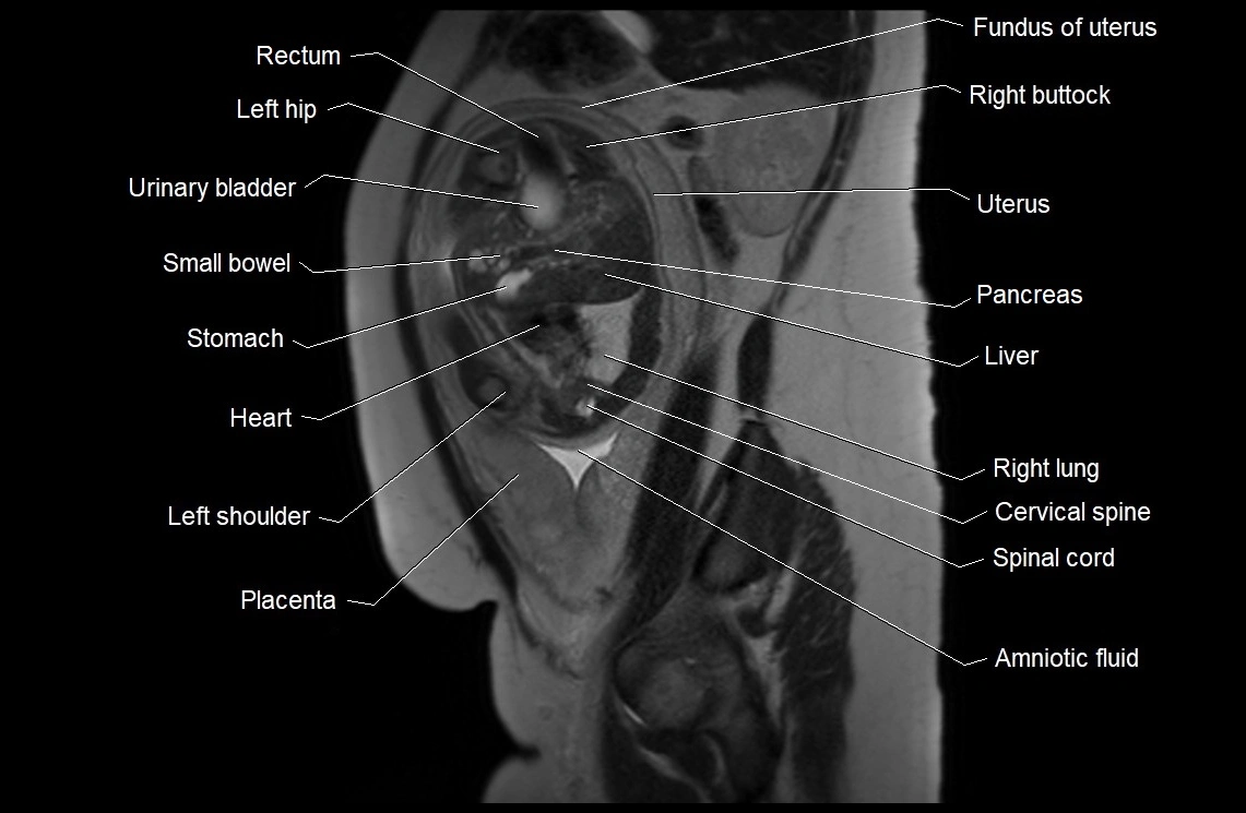 MRI fetal anatomy sagittal image 10.webp